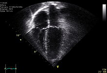 ארבעת מדורי הלב באקוקרדיוגרם, מבט מחוד הלב