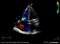 Soubor: Těžká trikuspidální regurgitace E00567 (CardioNetworks ECHOpedia) .webm