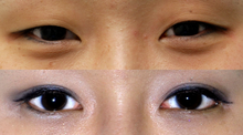 East Asian blepharoplasty, a surgery designed to add a crease to the eyelid, has become one of the most common facial surgical procedures in Asian countries Une Sud-Coreenne, avant (en haut) et apres (en bas) une blepharoplastie d'Asie de l'Est.png