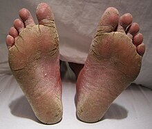 FeetFungal.JPG