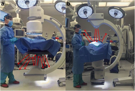 File:Scatter rays during interventonal radiology.webp