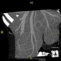 تصویر CT با حداکثر شدت پرتابی (MIP)، که وریدهای کبدی عبوری بر روی سطح قدامی کبد را در نمای قدامی نمایش می‌دهد.