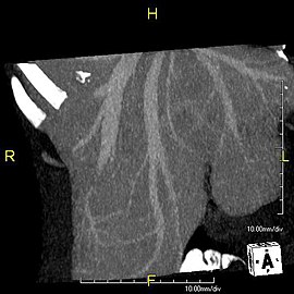 Anterior MIP image of anomalous hepatic veins.jpg