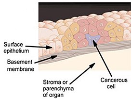 In situ carcinoma.jpg