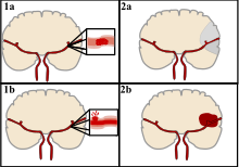 There are two main categories of stroke. Ischemic (top), typically caused by a blood clot in an artery (1a) resulting in brain death to the affected area (2a). Hemorrhagic (bottom), caused by blood leaking into or around the brain from a ruptured blood vessel (1b) allowing blood to pool in the affected area (2b) thus increasing the pressure on the brain. Ischemic Stroke.svg