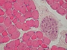 Cross section through skeletal muscle and a small nerve at high magnification (H&E stain) Skeletal muscle - cross section, nerve bundle.jpg