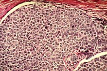 Breast cancer cells Breast cancer cells.jpg