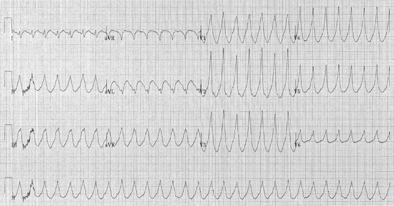 Archivo:Electrocardiogram of Ventricular Tachycardia.png