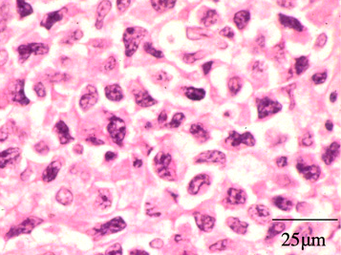 Extranodal NK/T cell lymphoma, nasal type for comparison.[16] These lymphoma cells are typically monotonous, with folded nuclei, indistinct nucleoli and moderate amount of cytoplasm.[17]