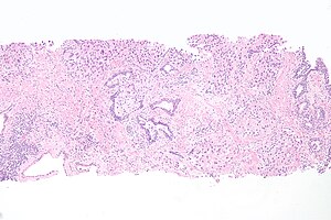 Uretrální uroteliální buněčný karcinom.jpg