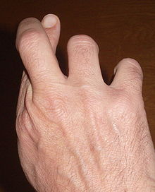 Photo of hand with index finger and second finger crossed at the first joint.