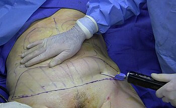 English: A 40-year old woman undergoing a comb...