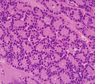 Гистопатология ацинарно-клеточного рака поджелудочной железы.jpg