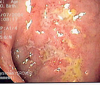 Endoscopy image of colon showing serpiginous u...