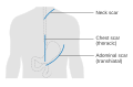 Diagram showing the possible scar lines after surgery for oesophageal cancer