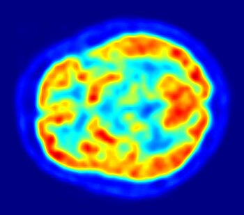 This is a transaxial slice of the brain of a 5...