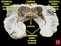 Brain dissected after Pr. Nicolas method - second piece