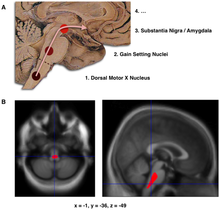 Composite of three images, one in the top row (referred to in caption as A), two in the second row (referred to as B). Top shows a mid-line sagittal plane of the brainstem and cerebellum. There are three circles superimposed along the brainstem and an arrow linking them from bottom to top and continuing upward and forward towards the frontal lobes of the brain. A line of text accompanies each circle: lower is "1. Dorsal Motor X Nucleus", middle is "2. Gain Setting Nuclei" and upper is "3. Substantia Nigra/Amygdala". The fourth line of text above the others says "4. ...". The two images at the bottom of the composite are magnetic resonance imaging (MRI) scans, one sagittal and the other transverse, centred at the same brain coordinates (x=-1, y=-36, z=-49). A colored blob marking volume reduction covers most of the brainstem.