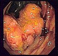 Endoscopic image of colon cancer identified in sigmoid colon on screening colonoscopy in the setting of Crohn's disease