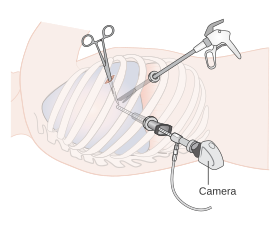 Диаграмма, показывающая видеоассистированную торакоскопию (VATS) CRUK 378.svg