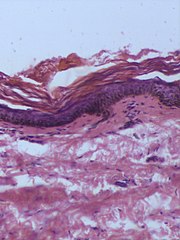 Гигантский меланоцитарный невус - histopathology.jpg