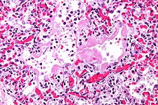 Micrograph of diffuse alveolar damage, the histologic correlate of TRALI. H&E stain
