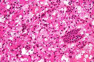 Cerebelární hemangioblastom vysoký mag.jpg