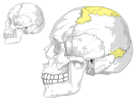 Huesos wormianos en comparación con un cráneo normal