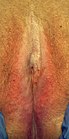 Lichen sclerosus der Vulva.
