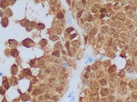 β-catenin immunohistochemistry in solid pseudopapillary tumor, staining the nuclei in 98% of such cases.[11] Cytoplasm is also staining in this case.