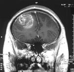 http://upload.wikimedia.org/wikipedia/commons/thumb/c/cb/Glioblastoma_-_MR_coronal_with_contrast.jpg/150px-Glioblastoma_-_MR_coronal_with_contrast.jpg