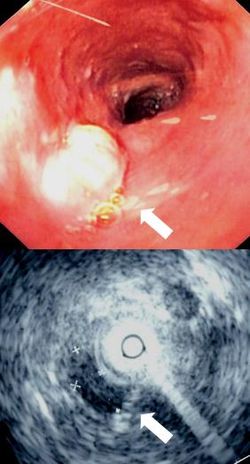 Mid esophageal mass.jpg