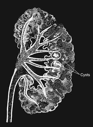 N00728 H-1- medullary sponge kidney.JPG