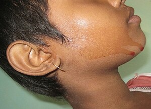 Hematohidrosis-Indian-Journal-Dermatology-Dermatol-2013-58-6-478-119964-f1.jpg
