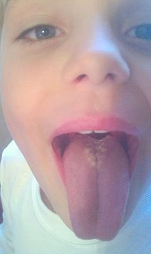 Rhomboid Tongue