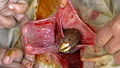 ساق لجنين حَمَل تخرج من الرحم أثناء إجراء عملية ولادة قيصرية.