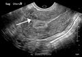 A small uterine fibroid seen within the wall of the myometrium on a cross sectional ultrasound view
