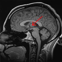 Sezione MRI, in cui è indicato il talamo