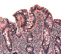 Biopsy of :en:small bowel showing :en:coeliac ...