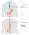 Illustrazione prima e dopo una esofagectomia totale