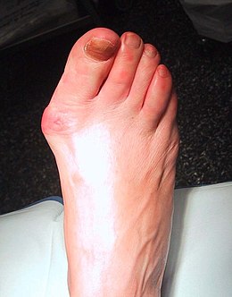 Description de l'image Hallux Valgus-Aspect pré op décharge.JPG.