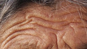 English: Skin folds of an old lady from Zacate...