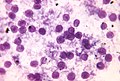 Smear of Pneumocystis carinii. 
 Toluidine blue stain PHIL 596 lores.jpg