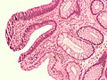 Adenoma tubular (a esquerda) e mucosa saudável (a direita). H&E.