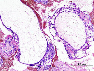 Hydatidiform mole (1) complete type.jpg