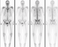 Normal bone scan in a person with osteopoikilosis