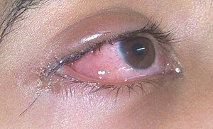 oedema of the conjunctiva due to hay fever allergy