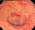 Miniatura para Colitis ulcerosa