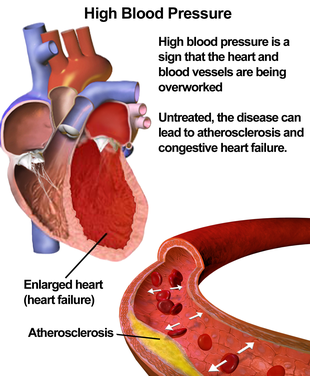 Illustration depicting the effects of high blood pressure Blausen 0486 HighBloodPressure 01.png
