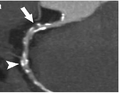 CT-Angiographie; mittels multiplanarer Reformation (hier die sog. curved MPR) sind auch Schnittdarstellungen entlang beliebiger Gefäßverläufe möglich, wodurch die gezeigte Arteriosklerose sehr gut visualisiert werden kann.